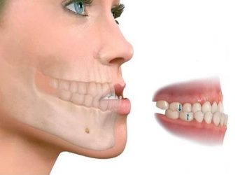 #КЫСКА_НУСКА: "Прикус" деген эмне жана эмне үчүн аны оңдоо керек?