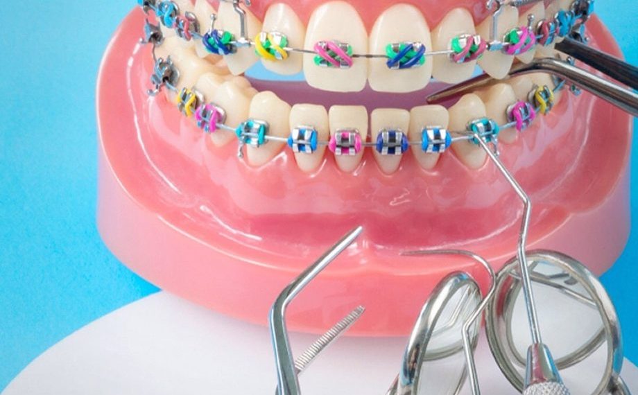 #КЫСКА_НУСКА: Брекет жөнүндө эмнелерди билүү керек?