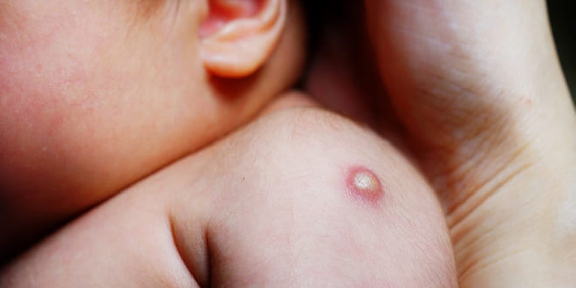 Балдарды кургак учуктан сактоо үчүн жасалган БЦЖ эмдөөсү тууралуу 8 факт