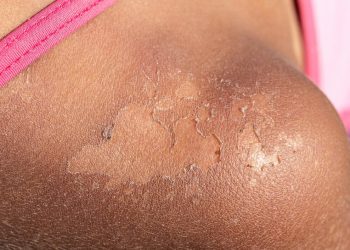 Бир жериңизди күйгүзгөндө тиш пастасын сүйкөбөңүз! Дарыгер кеңеш берет