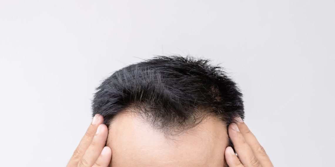 Шапка көп кийсең маңдайыңдагы чач түшө баштайбы? Трихолог жооп берет