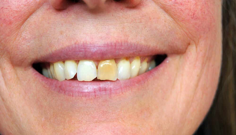 Тишти саргаруудан кутулткан 4 пайдалуу ыкма