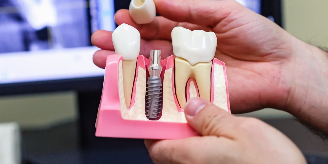 Тиш имплантаттары тууралуу бул 5 калпка ишенбеңиз