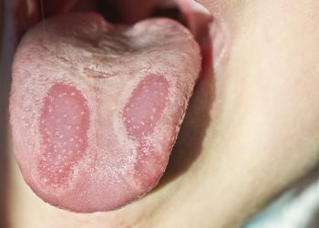 Бул оорулардын айынан тил агара баштайт